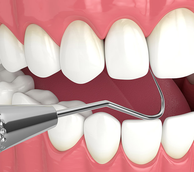 Hialeah Interactive Periodontal Probing