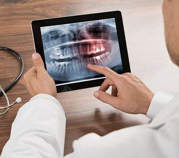 Hialeah Types of Dental Root Fractures